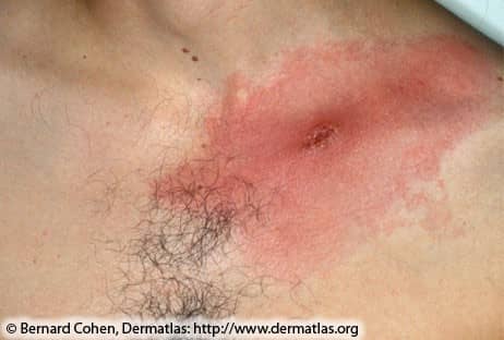 Lyme Disease Rash 2A