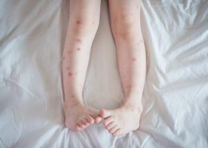 Bed bug bites