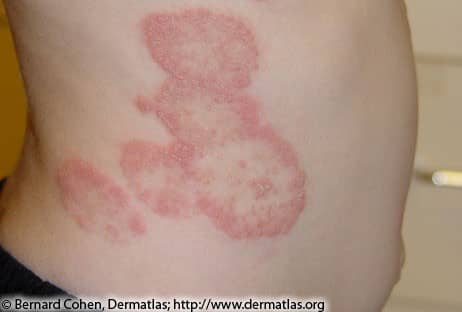 Lyme Disease Rash 1B