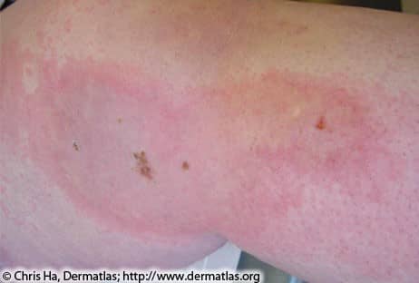 Lyme Disease Rash 2B