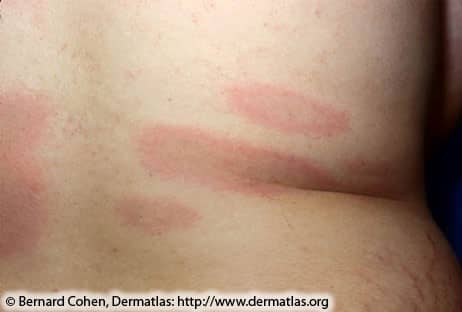 Lyme Disease Rash 3A