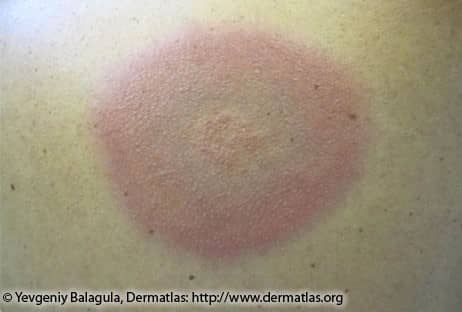 Lyme Disease Rash 4A