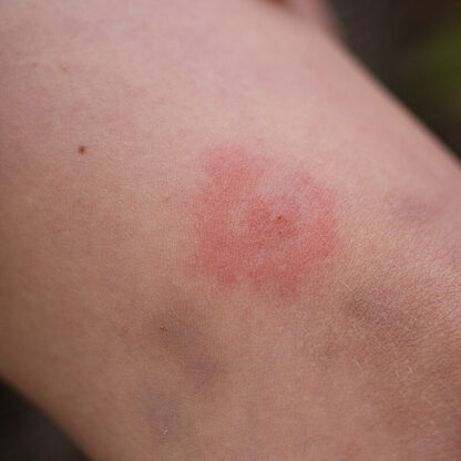 Photo of a Bullseye Rash from a Deer Tick that could signify potential Lyme Disease
