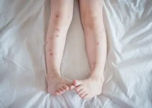 Bed bug bites